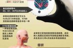 h7n9診療方案 衛(wèi)計委公