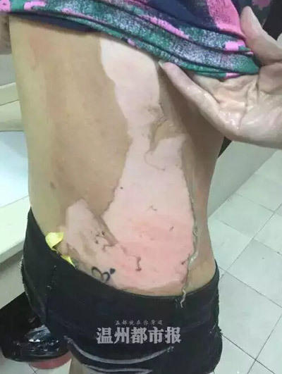 女子遭服務(wù)員潑熱湯